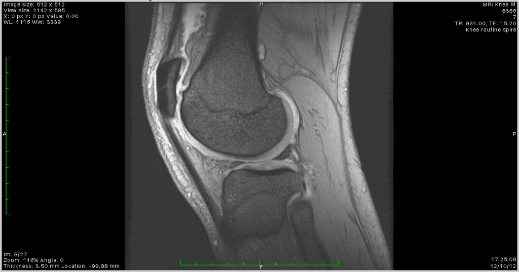 positional therapy for sleep apnea
