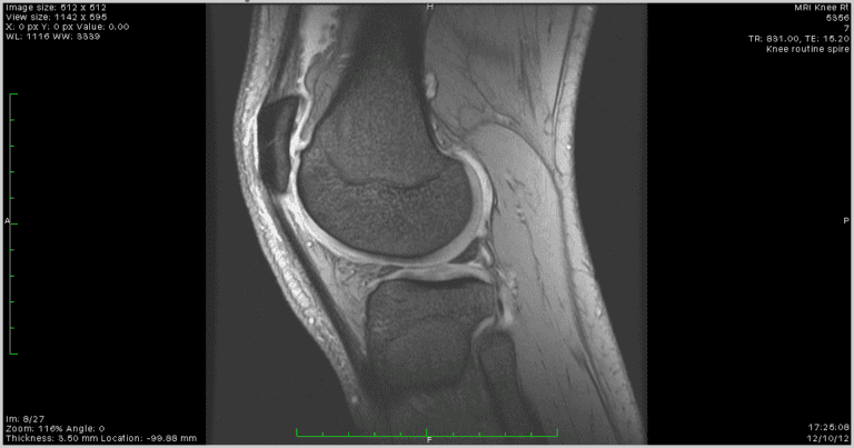 positional therapy for sleep apnea